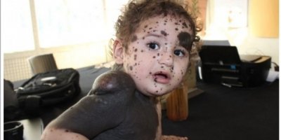 Vücudunda leke ve kitle ile doğan bebek tedavi ediliyor