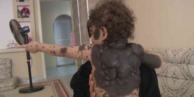 Vücudunda kitlelerle doğan bebeğinin tedavi edilmesini istiyor