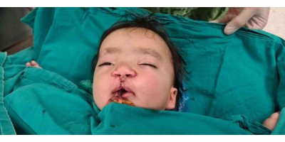 Yarık damak ve dudaklı bebeğe "Türk lalesi" ameliyatı