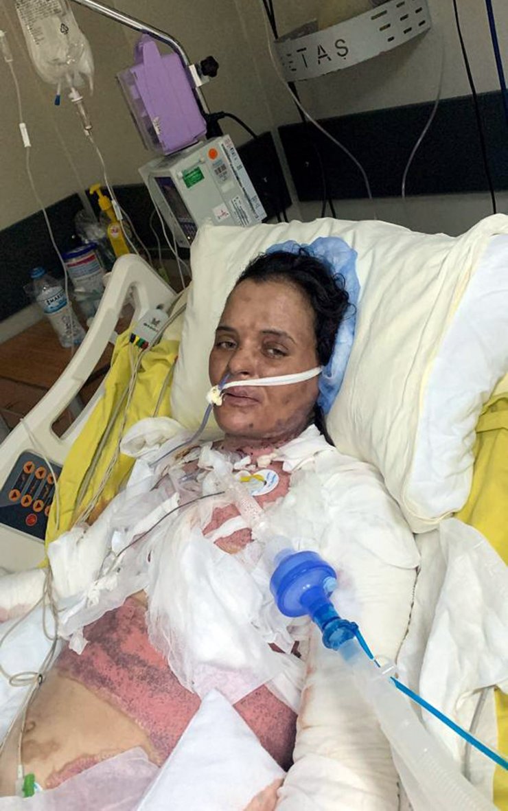 Dezenfektanın parlamasıyla yanan Havva, 75 gündür yoğun bakımda